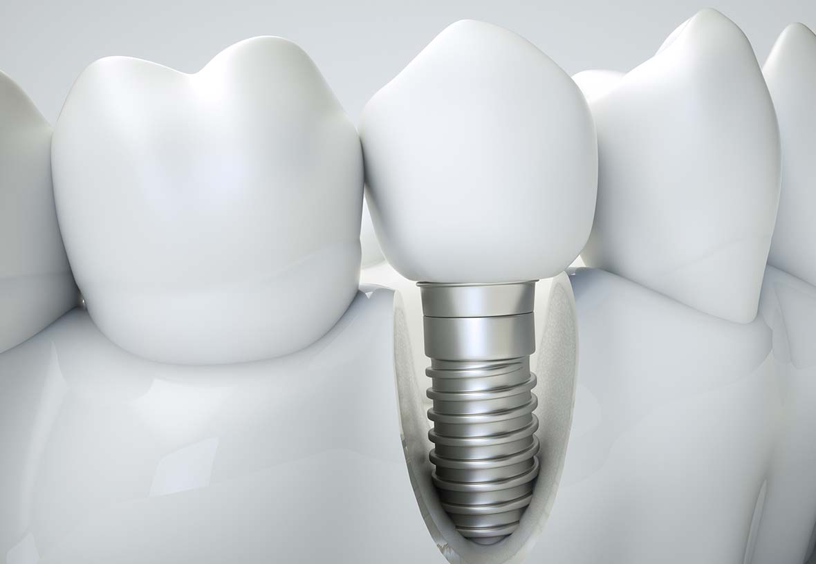 Dental Implants in Victoria Poplar Dental Centre